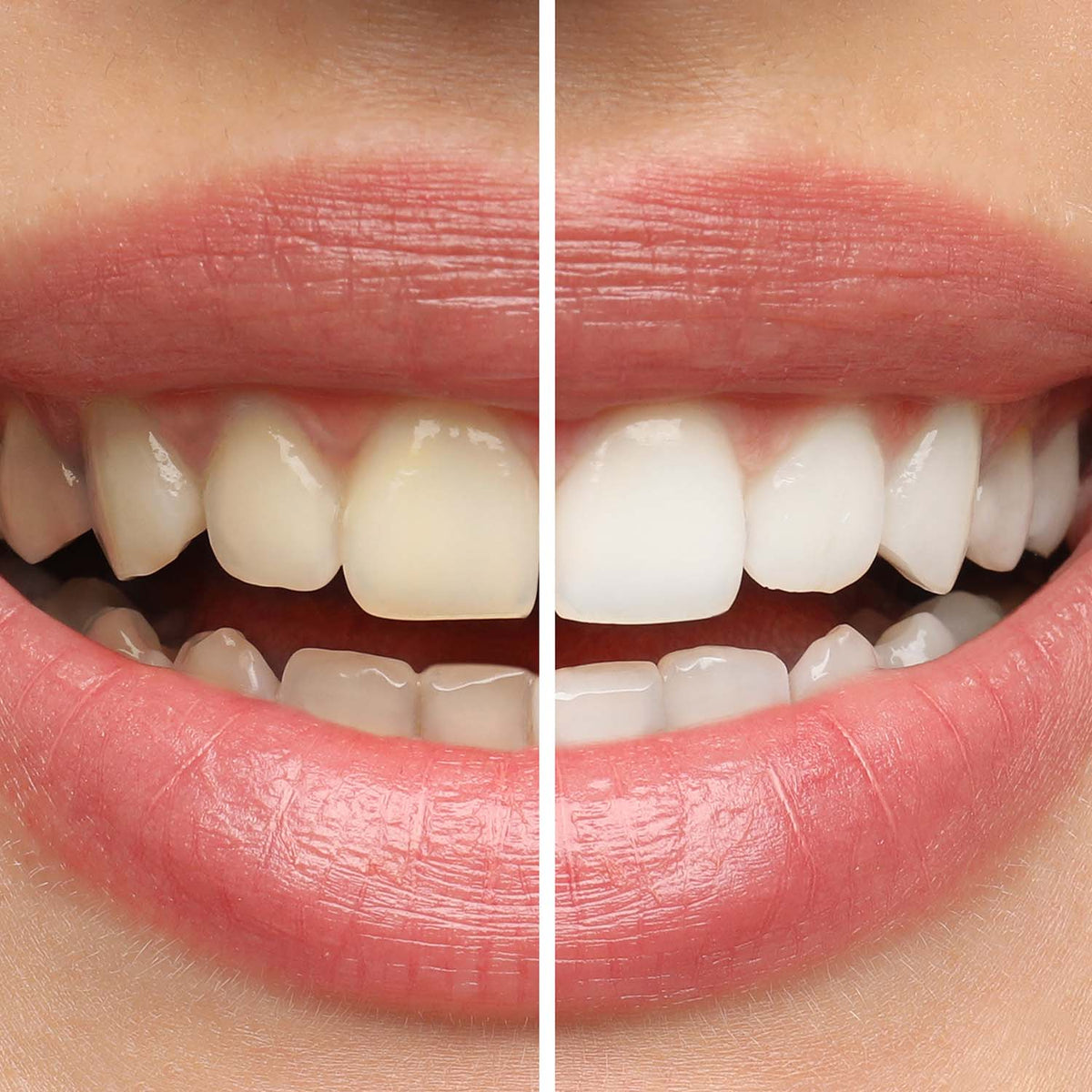 Sensitive Purple Whitening Strips